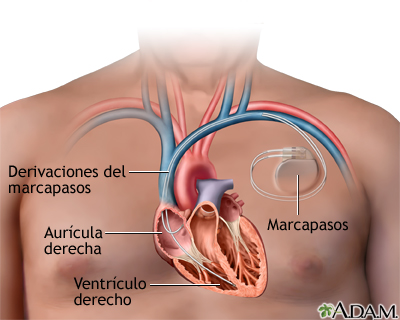Colocación de desfibrilador Cardioversion implantable Colocación de desfibrilador Cardioversion Implantable