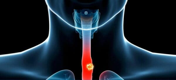 cáncer de esófago y el seguro médico en España