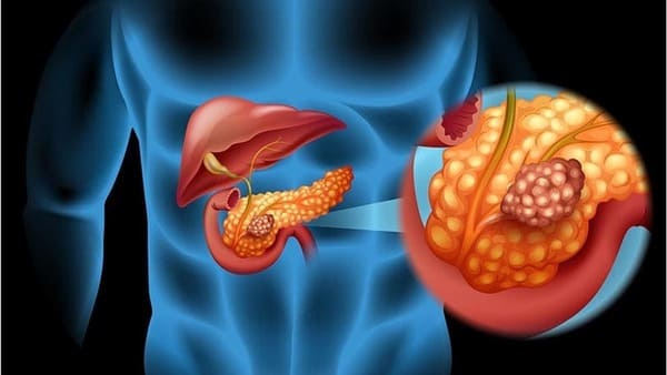 Cáncer de páncreas y el seguro médico en España
