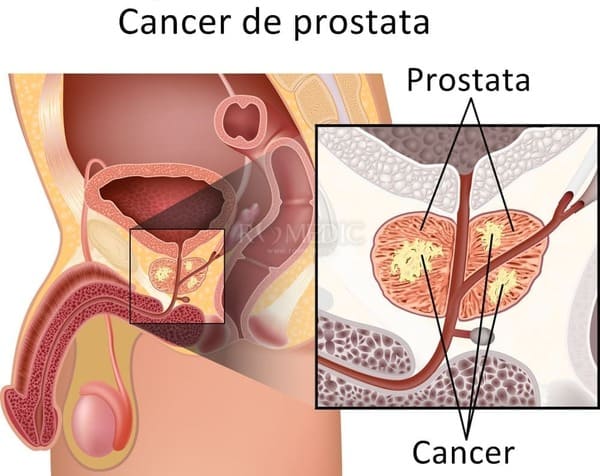Cáncer de próstata y el seguro médico en España