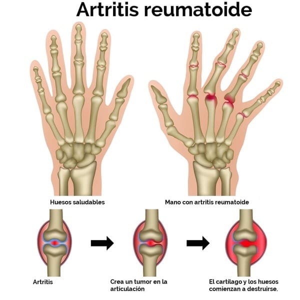Cubre el Seguro Médico la Artritis Reumatoide en España