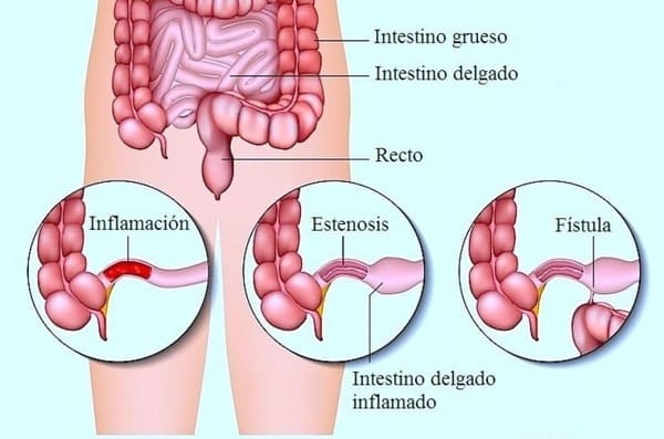 Cubre el Seguro Médico la Enfermedad de Crohn en España