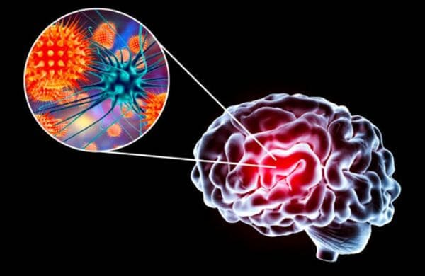 Meningitis y el seguro médico en España