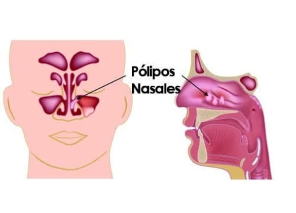 Rinosinusitis en España y el seguro médico