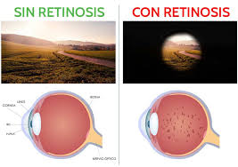 Retinosis Pigmentaria en España