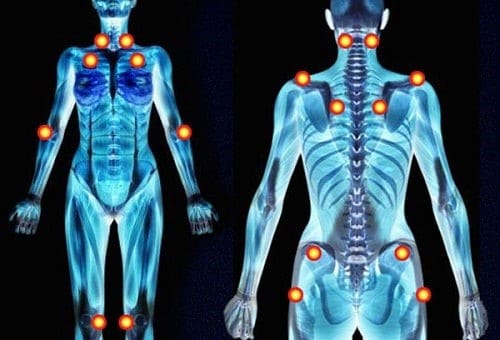 Dolores generalizados asociados a la fibromialgia