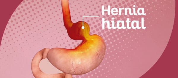 Hernia hiatal y el seguro médico en España