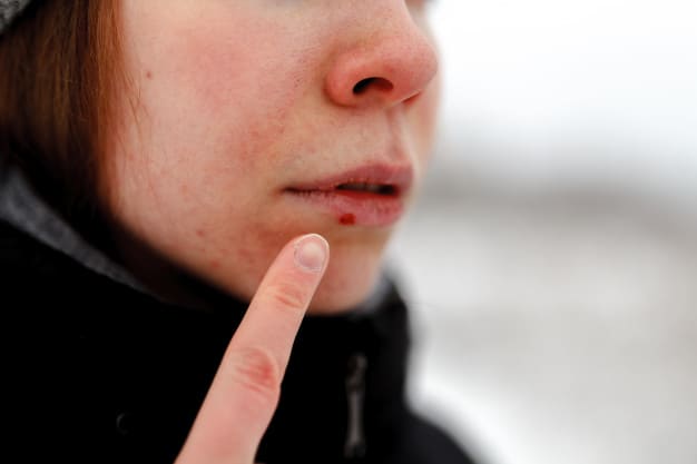 herpes y su incidencia en españa