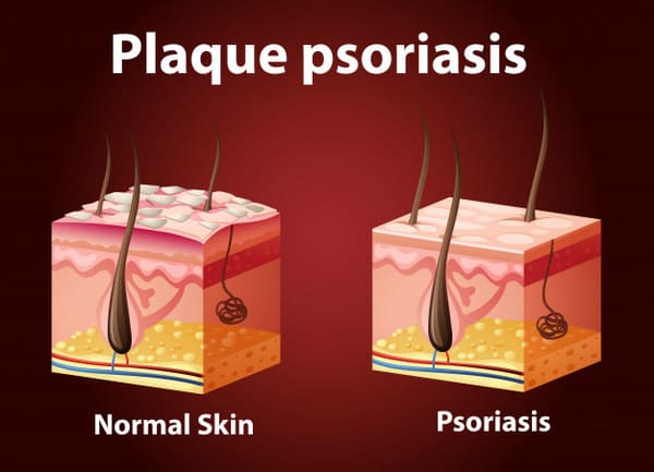 La Psoriasis y el Mejor Seguro Médico en España