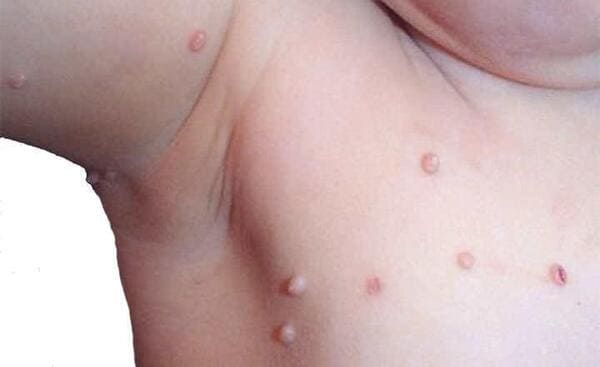 Molusco Contagioso en Niños y el Seguro Médico en España