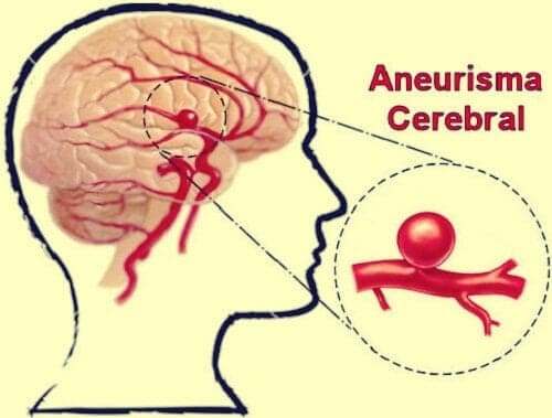 Aneurisma cerebral y los Seguros Médicos en España