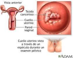 Lesiones en el cuello uterino