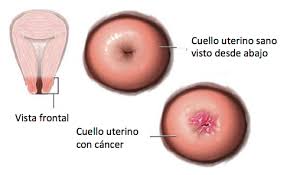 Cáncer de Cérvix y los Seguros en España