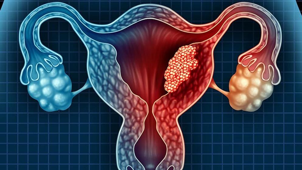 Las aseguradoras en España y el cáncer de útero