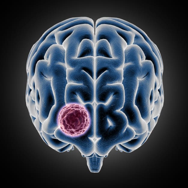 Tumor cerebral