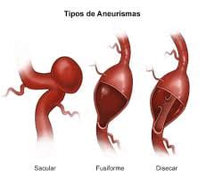 Tipos de aneurisma de acuerdo a su forma