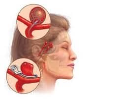 Tratamiento Aneurisma Cerebral