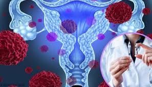 Causas del cáncer de cérvix y los seguros en España