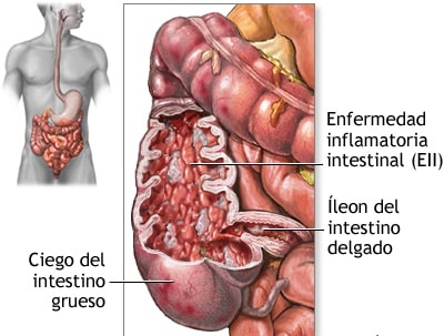 La Enfermedad Inflamatoria Intestinal en España