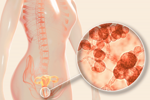 La candidiasis en España