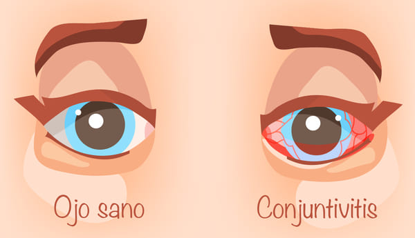 Conjuntivitis : Causas y Tratamiento en España