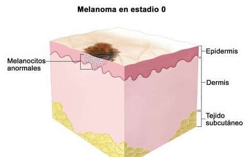Melanoma de Piel y los Seguros Médicos en España