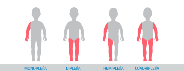 Parálisis Cerebral Infantil y el Seguro Médico en España