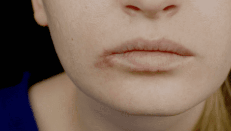¿Queilitis o boqueras? -Inflamación costra amarillenta • La aparición de costra amarillenta en la esquinas de la boca