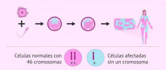 Síndrome de Turner en España y el Seguro Médico