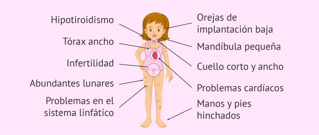 Síndrome de Turner en España y el Seguro Médico
