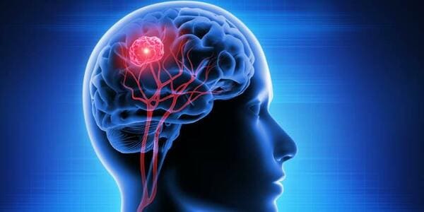 Tumores Cerebrales y el Seguro Médico en España