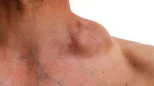 Ganglio inflamado en cuello