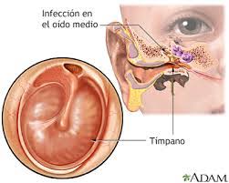 Inflamación e infección del oído medio