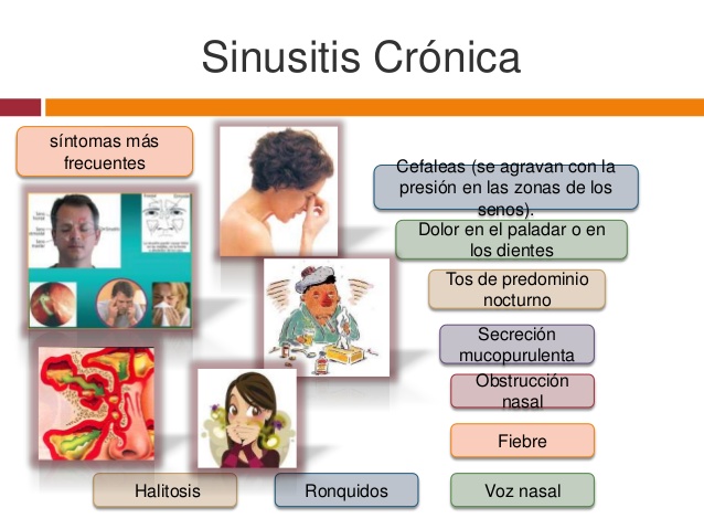 síntomas de la sinusitis bacteriana en España