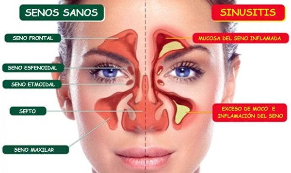 Sinusitis Bacteriana y El Seguro Médico en España