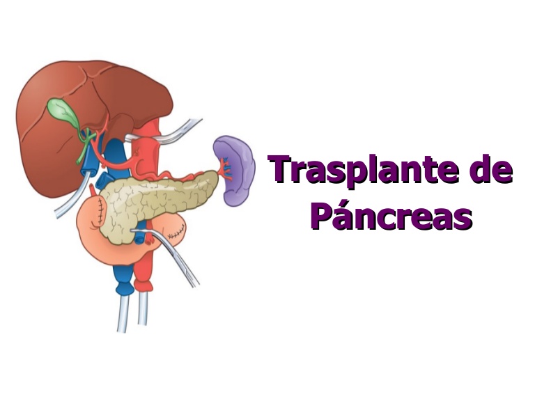 El trasplante de páncreas en España