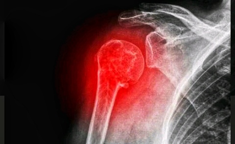  Osteogénesis Imperfecta en España