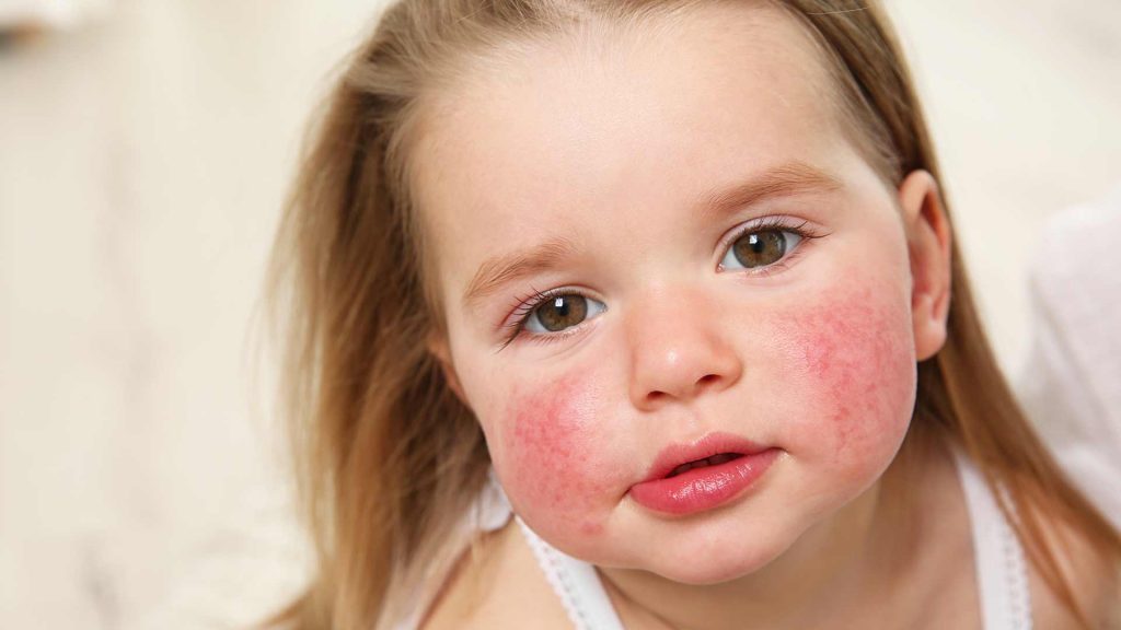 La Dermatitis Atópica y el Seguro Medico en España