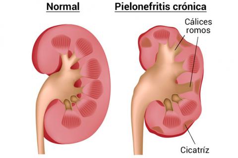 ¿Cubre el Seguro Médico la Pielonefritis?