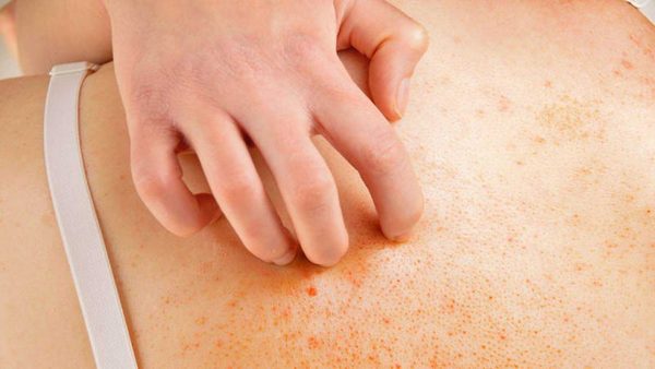 Cubre el Seguro de Medico las Enfermedades Dermatológicas en España
