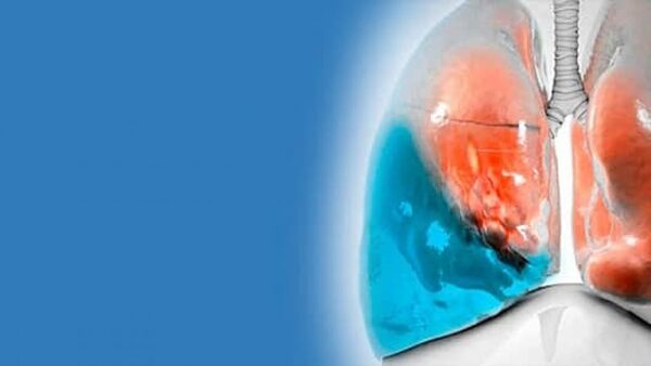 Derrame Pleural y el Seguro Medico en España