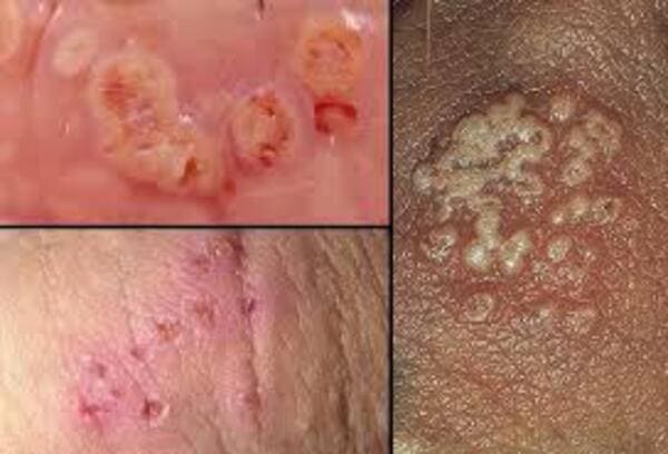 Herpes Genital