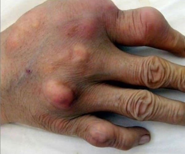 La Artrosis en los ancianos en España y El Seguro médico