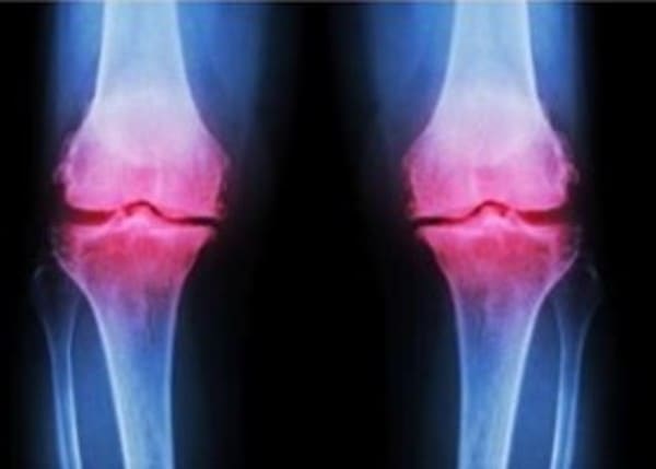 La Artrosis en los ancianos en España y El Seguro médico