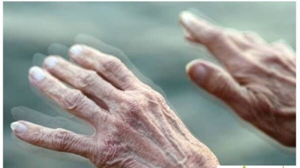 Mal de Parkinson y el Seguro Medico en España