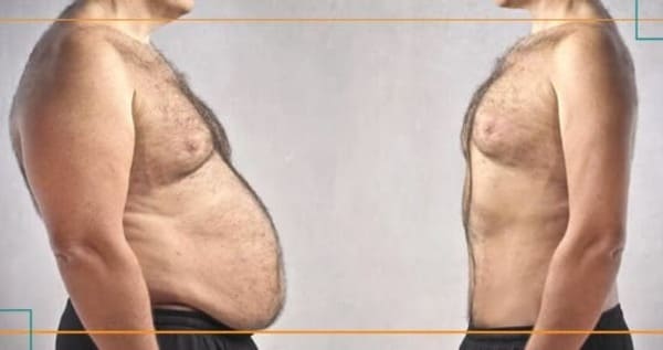 Mejor seguro de salud para cirugía Bariatrica en España