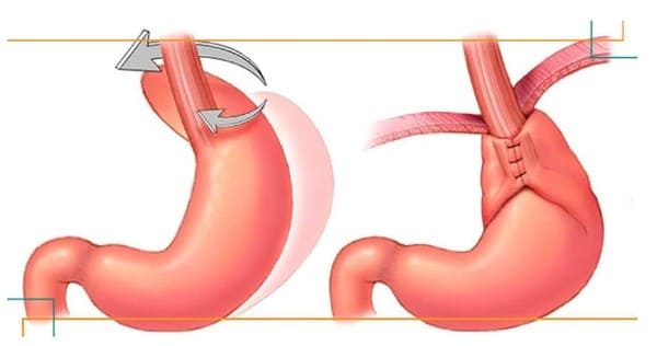 Mejor seguro de salud para cirugía Bariatrica en España