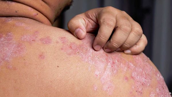 Psoriasis en España