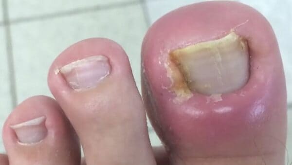 Uñas Encarnadas en España