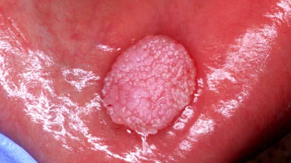 Virus del Papiloma Humano